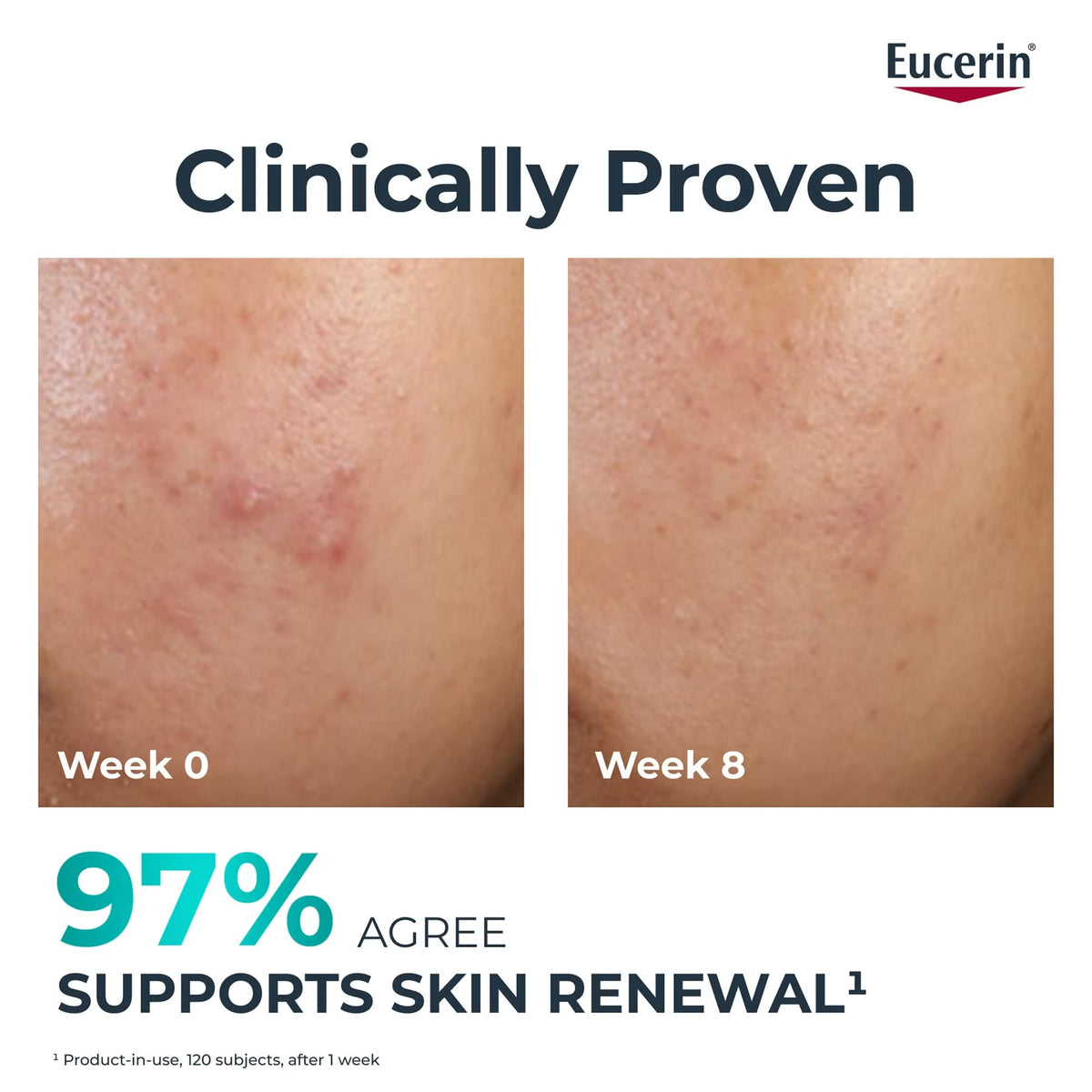 EUCERIN DERMOPURE CLINICAL PEELING 10 SOIN DE NUIT RENOVATEUR 40ML